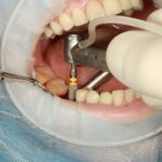 do dental implants hurt