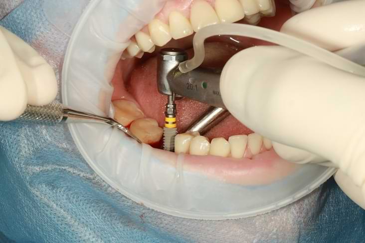 do dental implants hurt