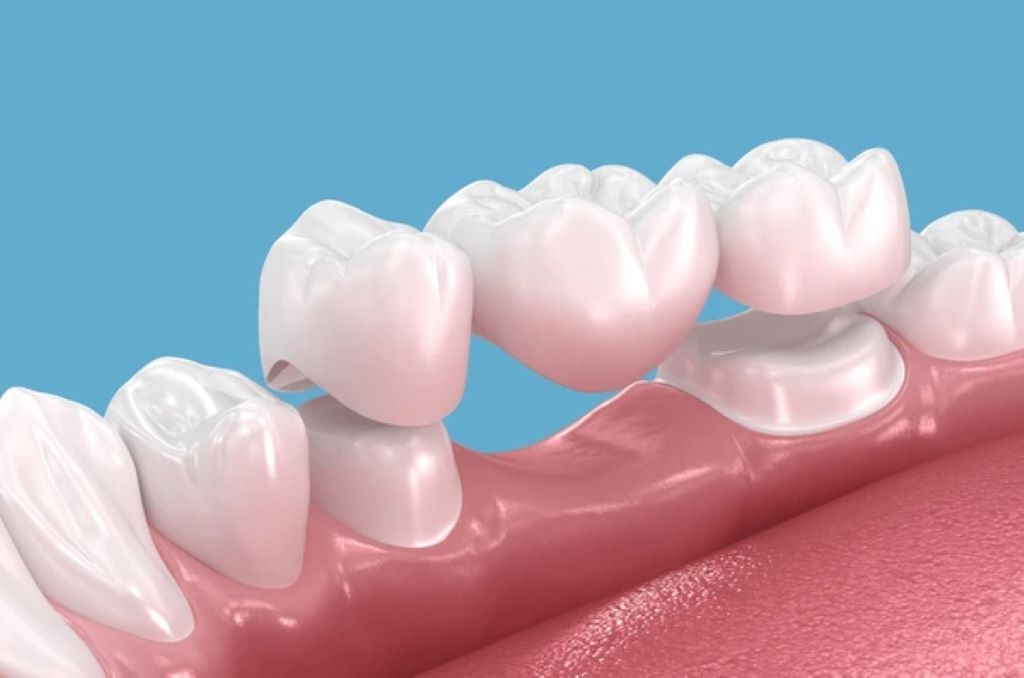 dental bridges near you
