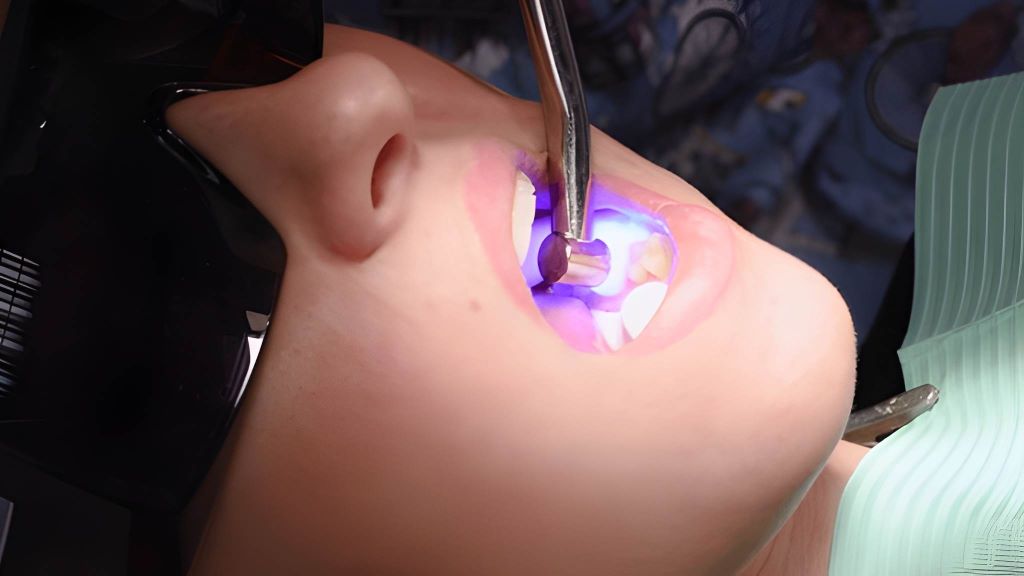 composite fillings near you