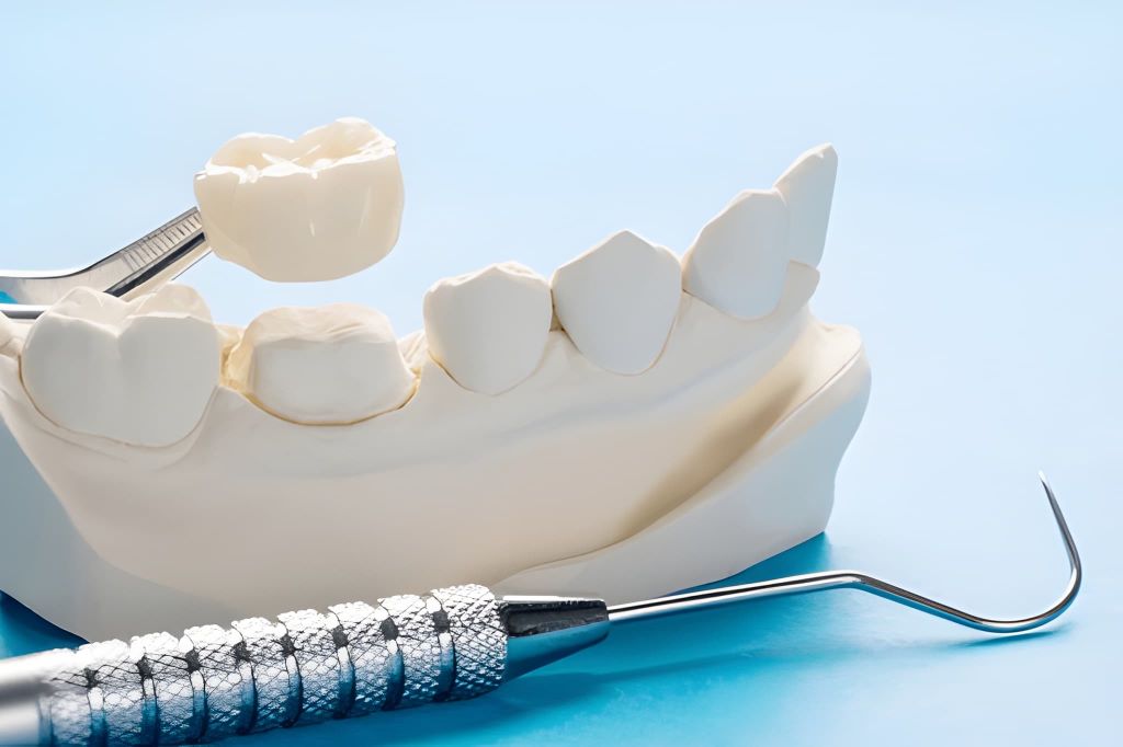 dental crowns in downtown calgary ab