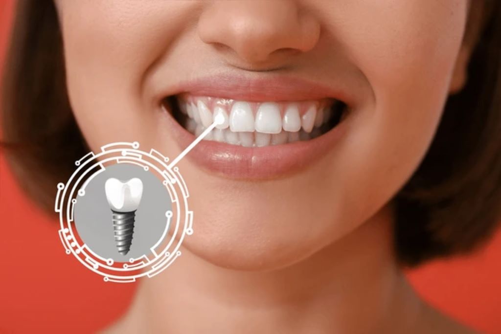 dental implants in downtown calgary ab