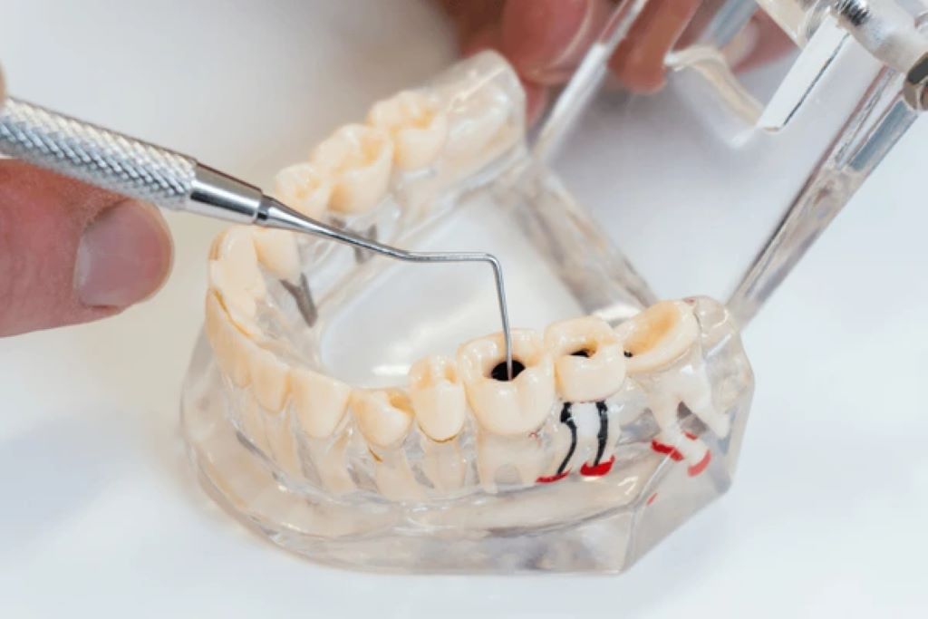 root canal therapy in downtown calgary ab