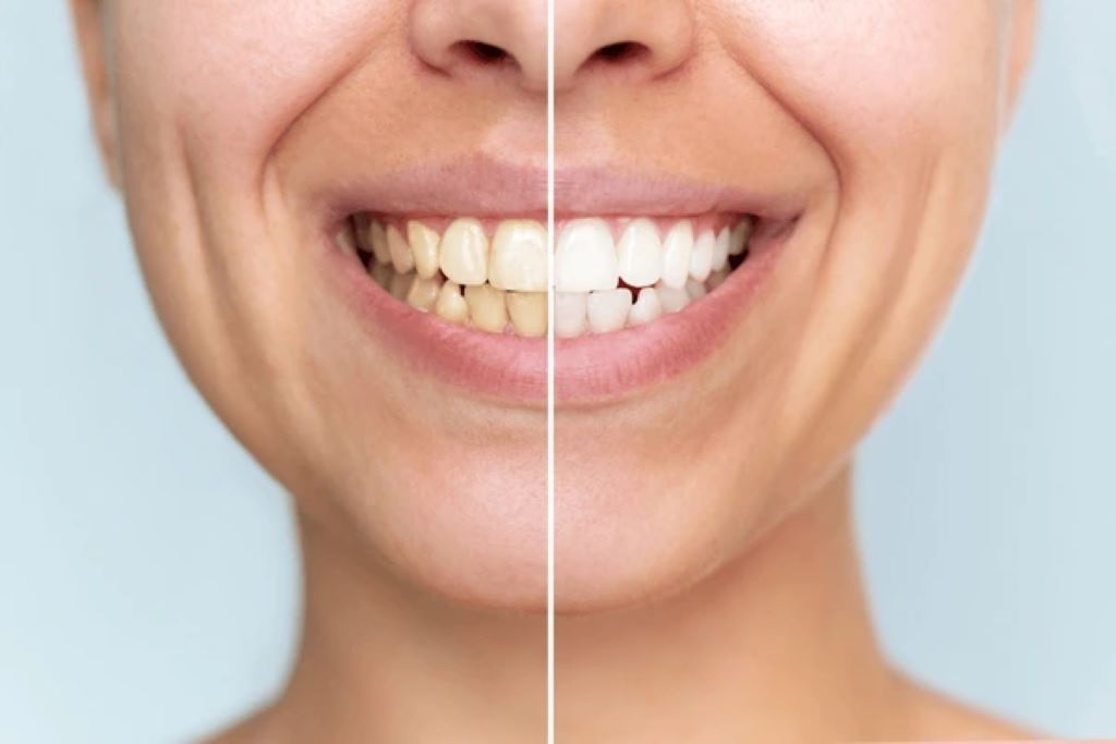 teeth whitening in downtown calgary ab